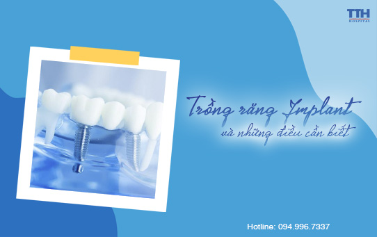 TRỒNG RĂNG IMPLANT VÀ NHỮNG ĐIỀU CẦN BIẾT